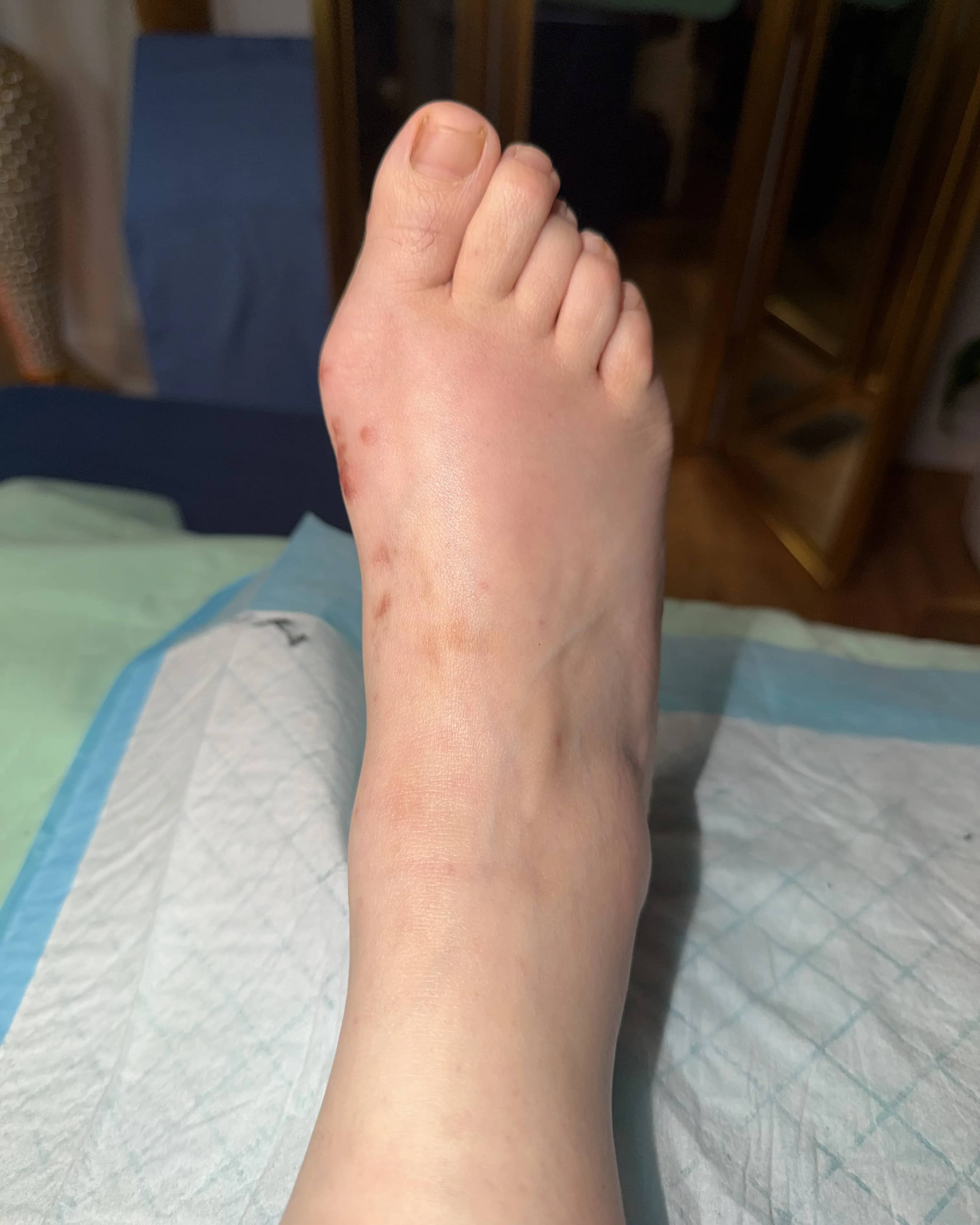 after bunion surgery