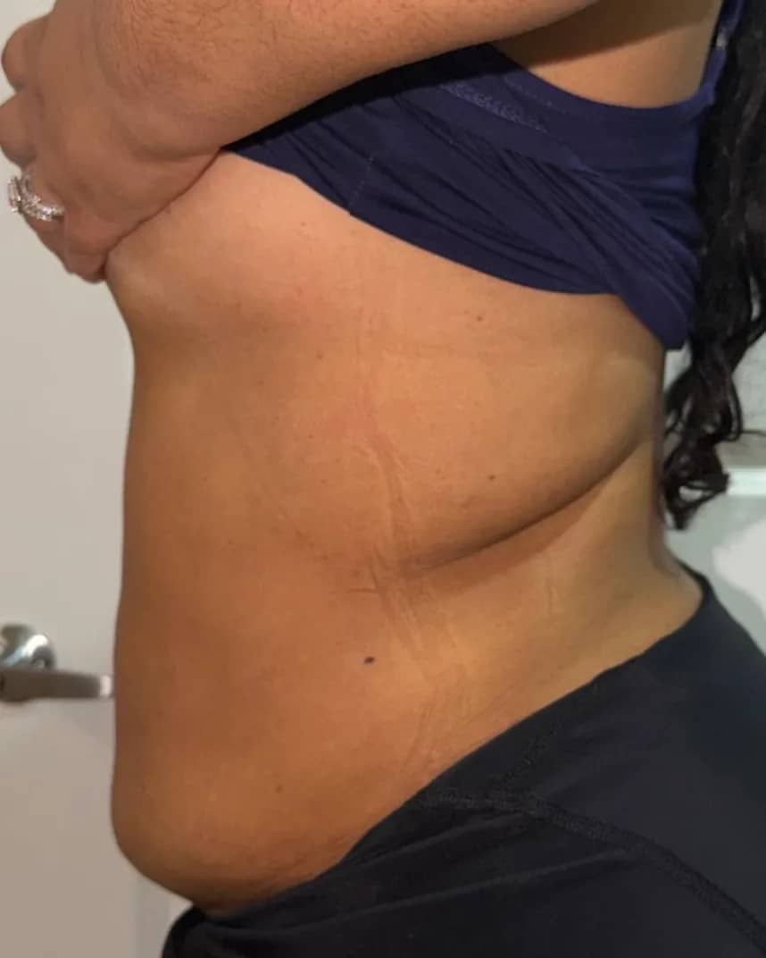 after abdominal lipo