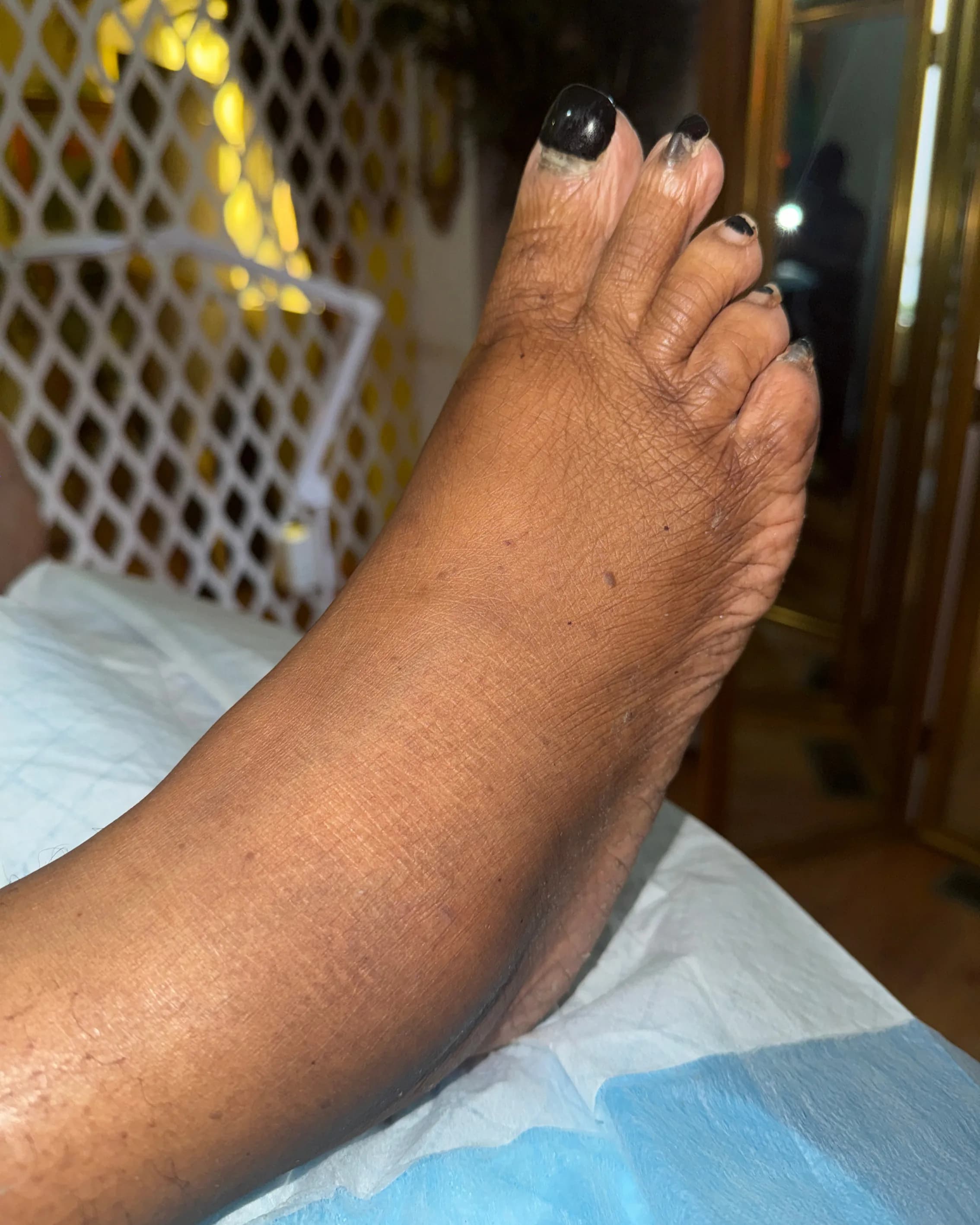 Ankle Reduced Swelling After