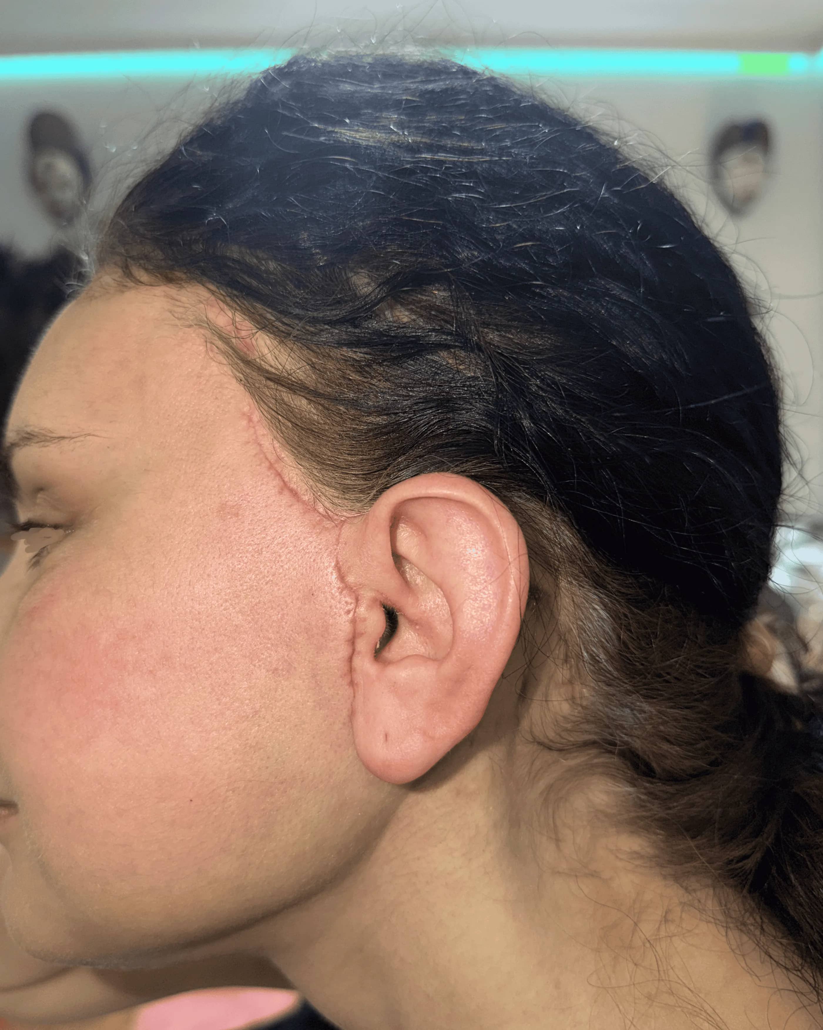 after face lift