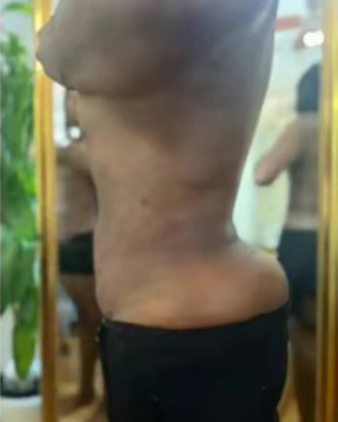 After 360 Liposuction With BBL at Magic Post Op, 6 weeks of lymphatic drainage post-op recovery progress.