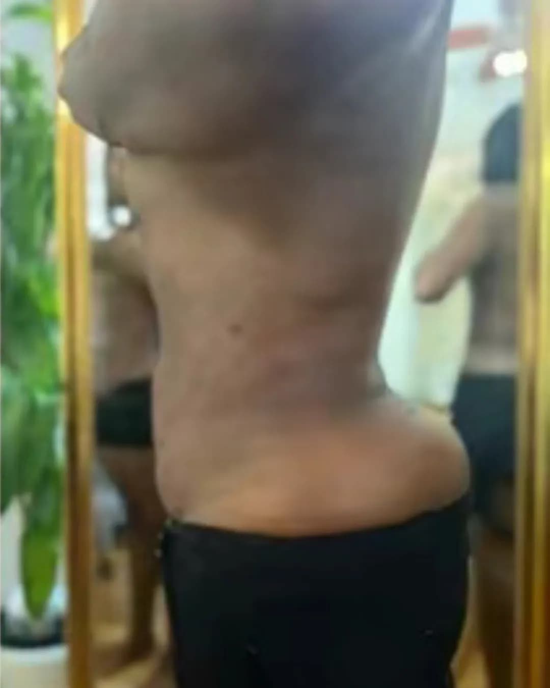After 360 Liposuction With BBL at Magic Post Op, 6 weeks of lymphatic drainage post-op recovery progress.