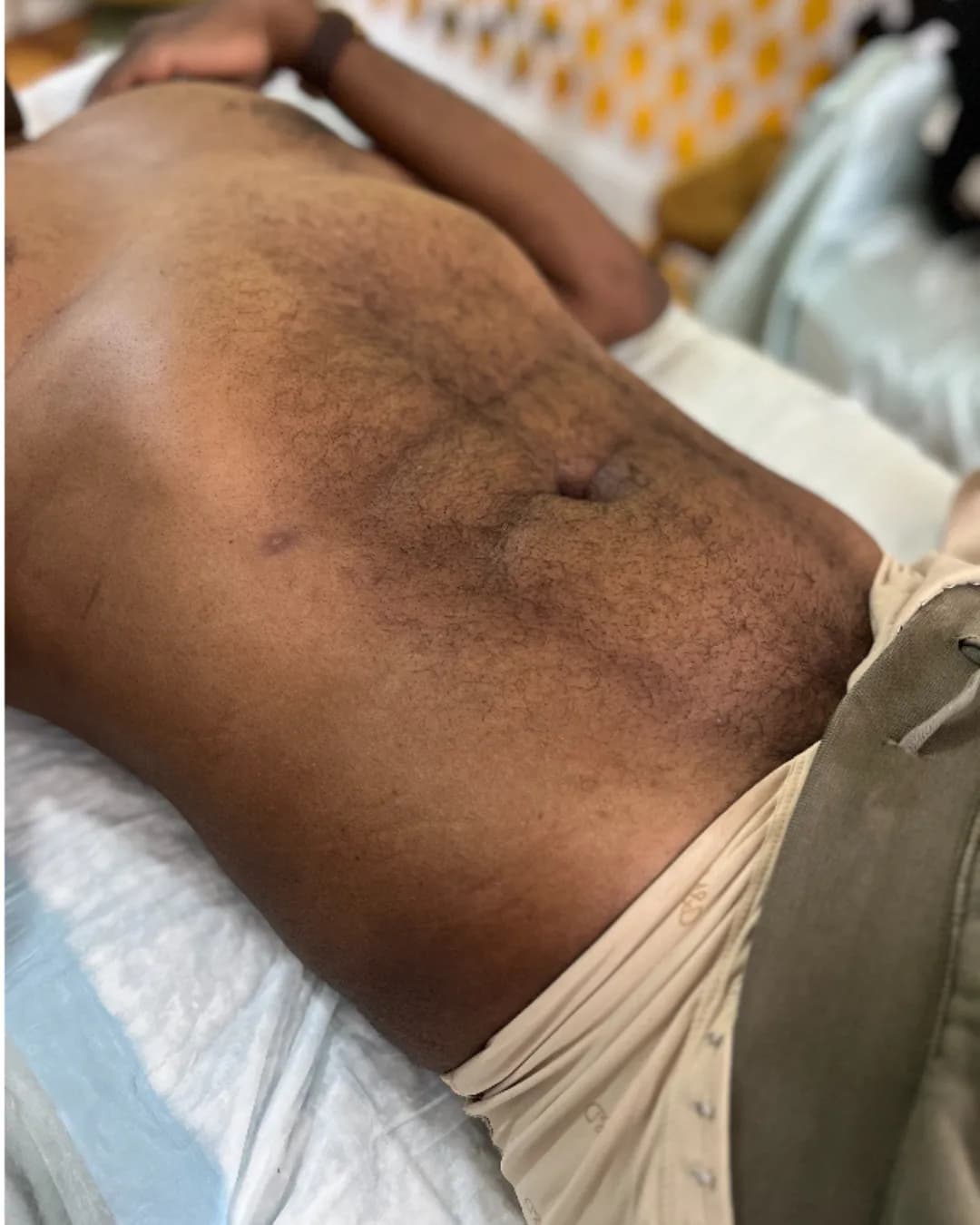 After 360 Liposuction With AB Etching at Magic Post Op, 11 weeks of lymphatic drainage post-op recovery progress.