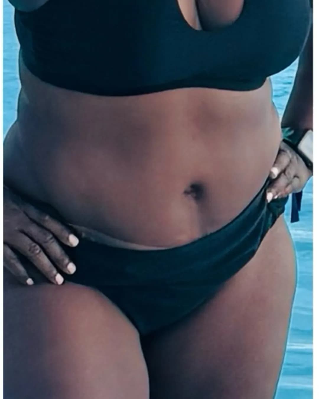 After Mommy Makeover at Magic Post Op, 5 weeks of lymphatic drainage post-op recovery progress.