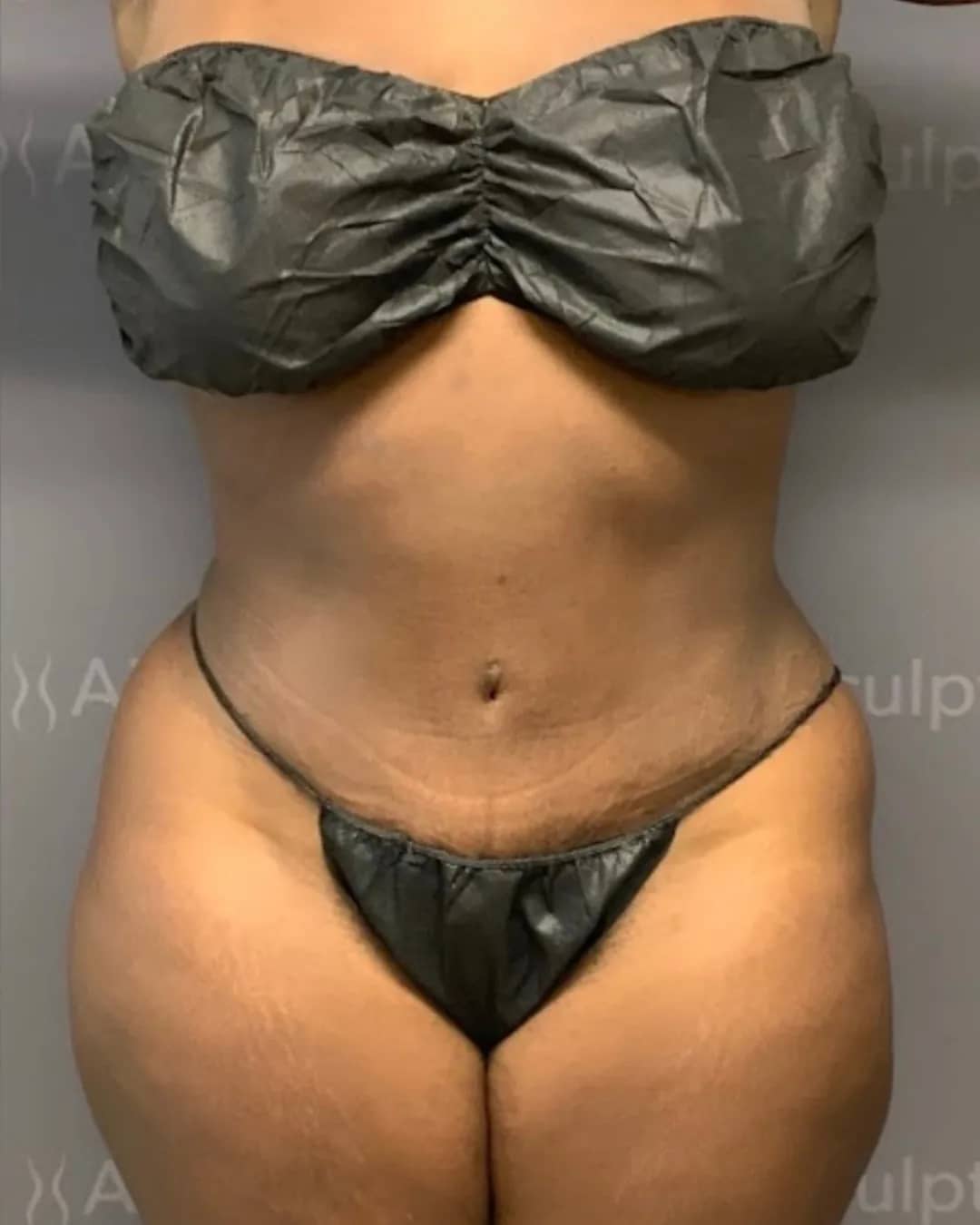 After Body Contouring at Magic Post Op, 8 weeks of lymphatic drainage post-op recovery progress.