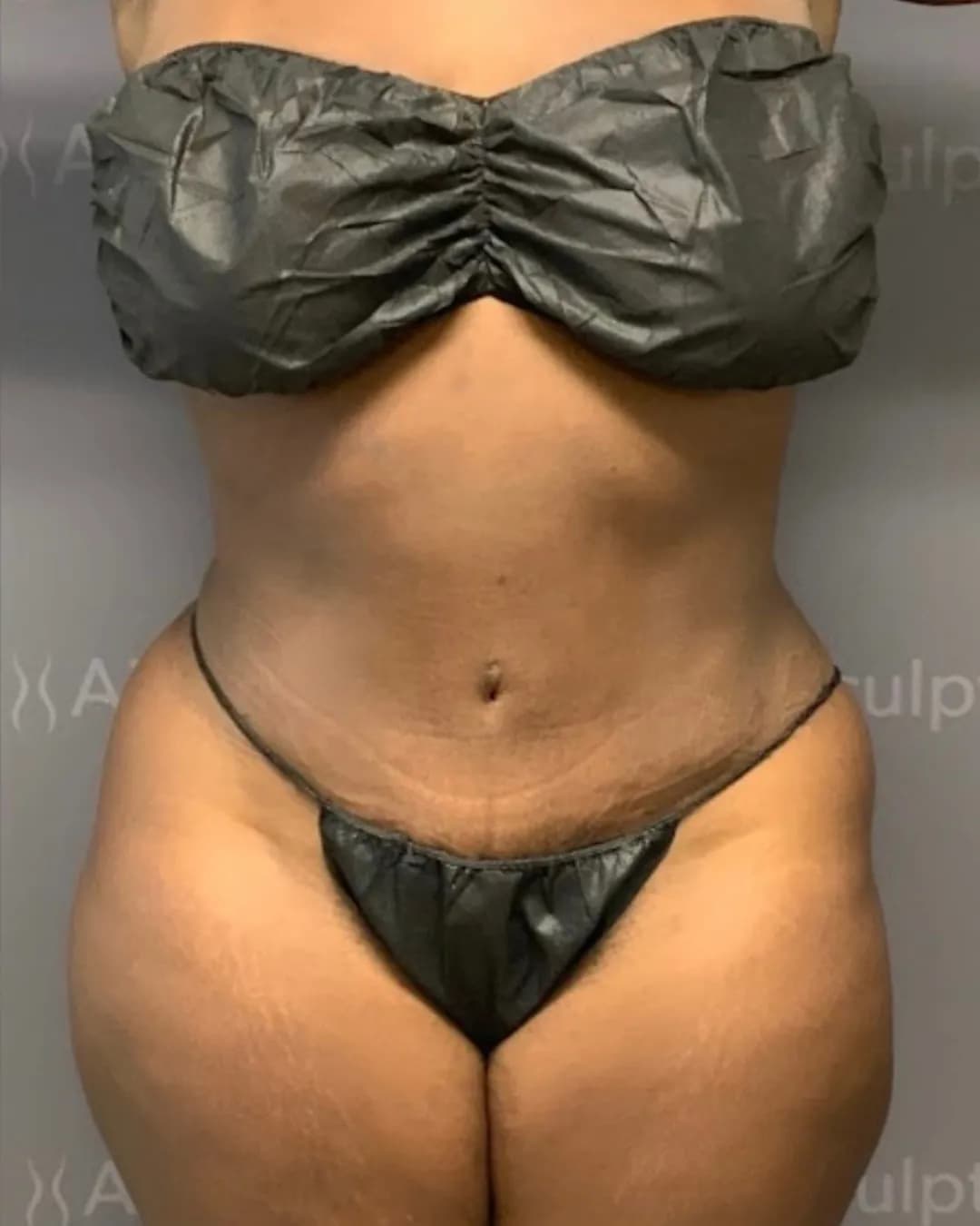 After Body Contouring at Magic Post Op, 8 weeks of lymphatic drainage post-op recovery progress.