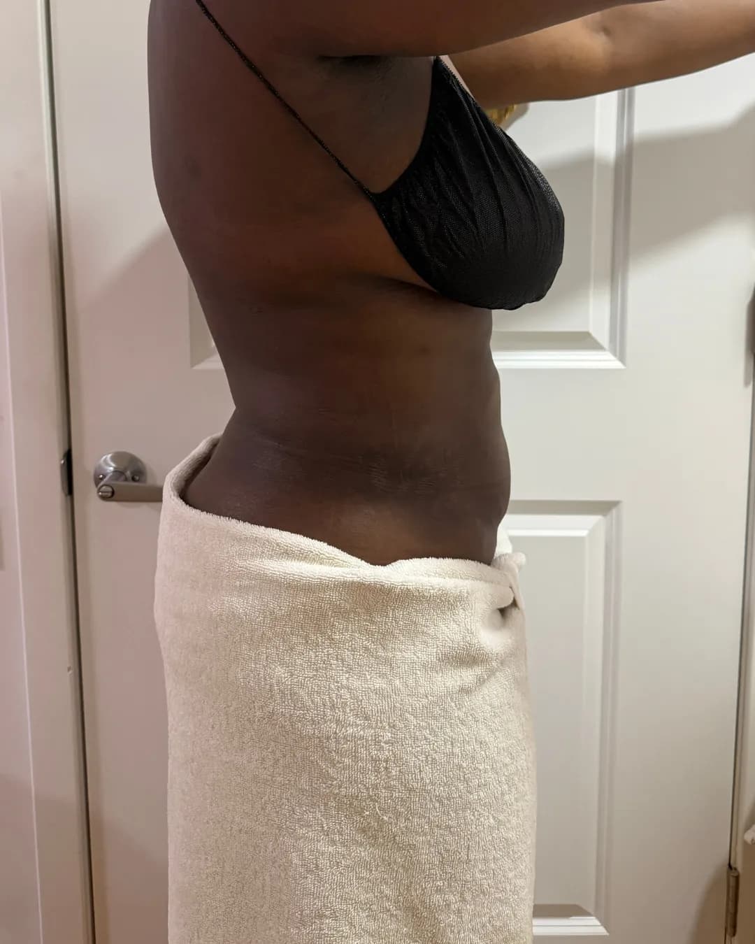 After 360 Liposuction at Magic Post Op, 7 weeks of lymphatic drainage post-op recovery progress.