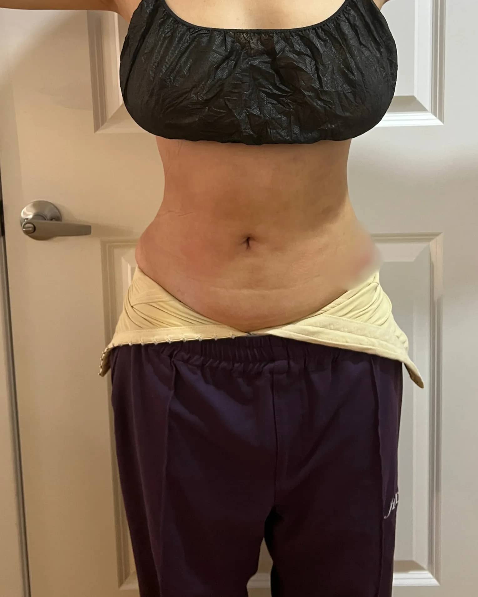 After Liposuction at Magic Post Op, 8 weeks of lymphatic drainage post-op recovery progress.