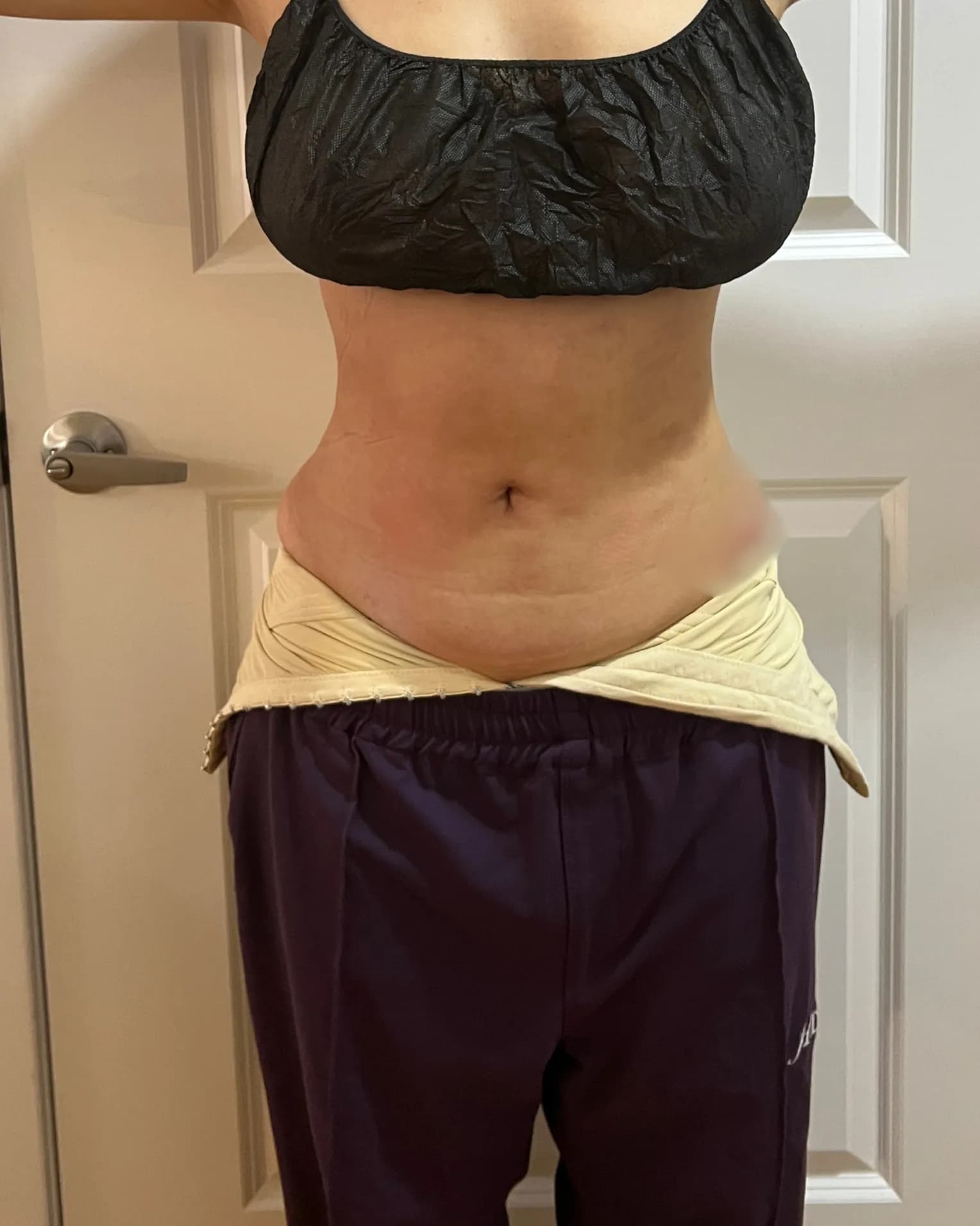 After Liposuction at Magic Post Op, 8 weeks of lymphatic drainage post-op recovery progress.