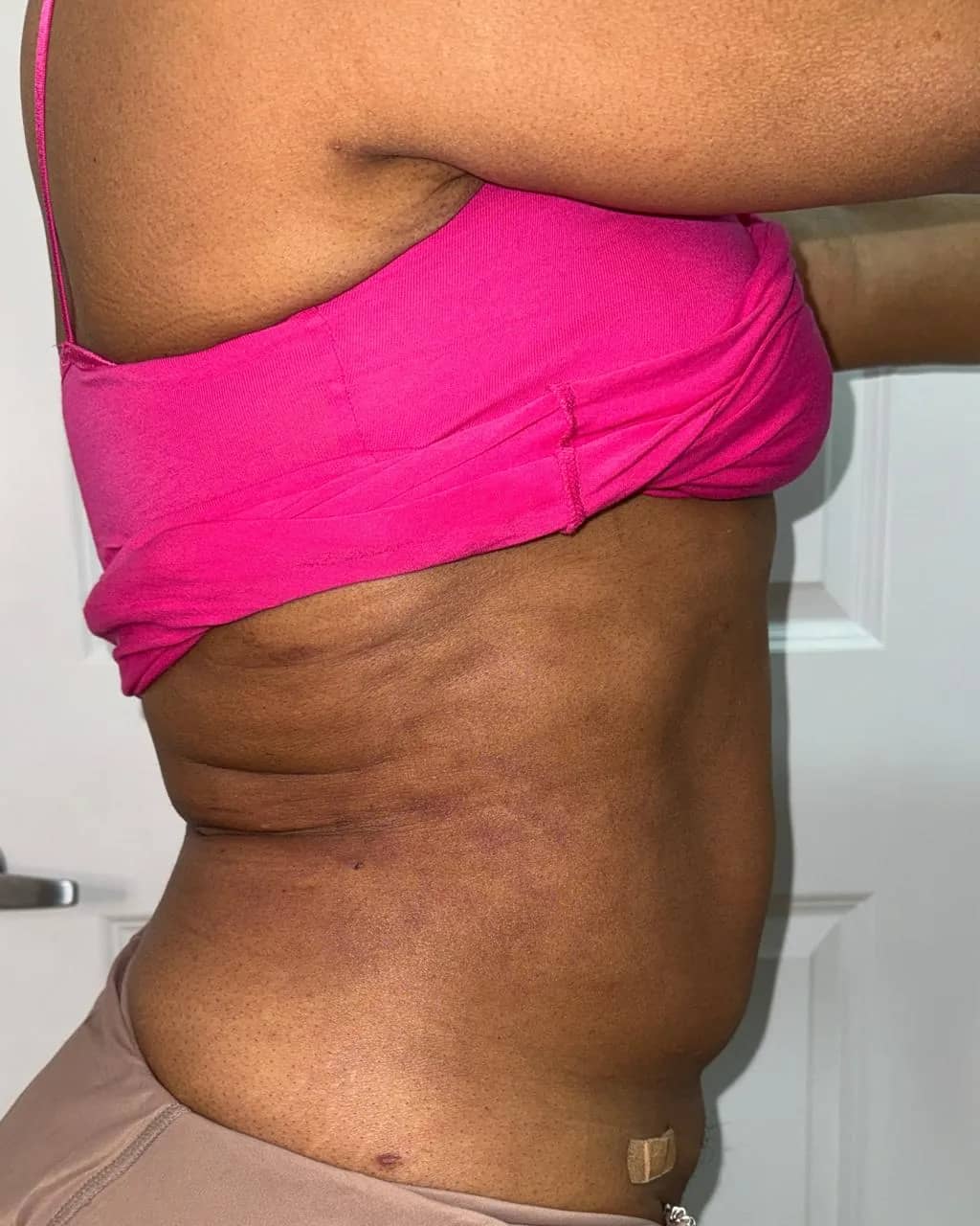 Side profile of the same midsection one week after flank and abdominal liposuction, showing reduced flank and abdominal fullness