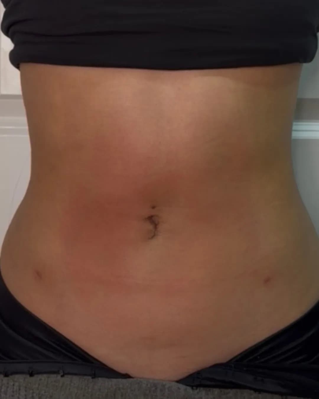 After Abdominal Liposuction at Magic Post Op, 2 weeks of lymphatic drainage post-op recovery progress.