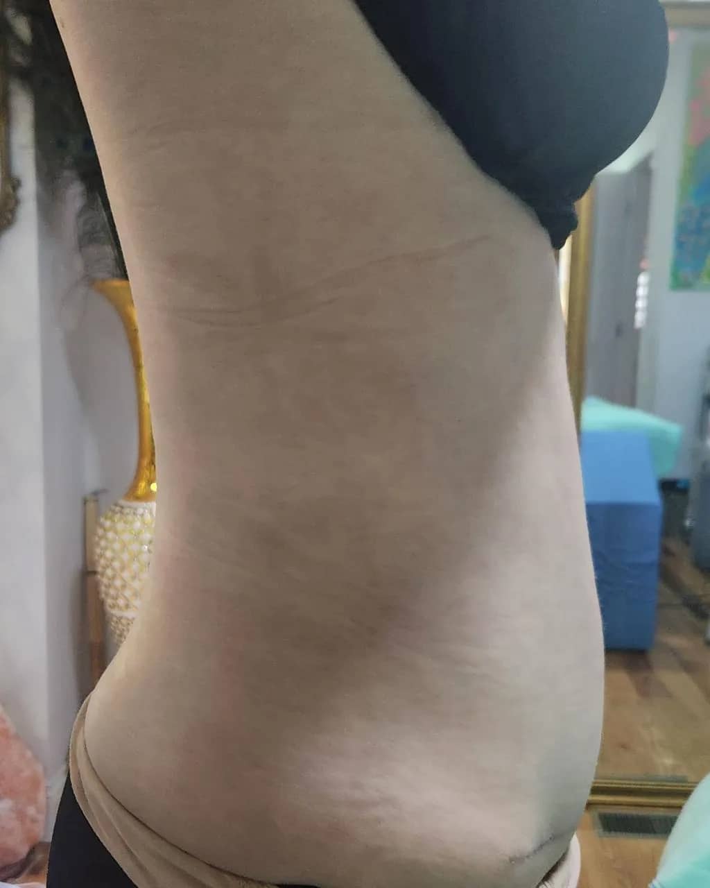 Side profile of the same midsection one month after 360 liposuction with a tummy tuck, showing a flatter, contoured abdomen