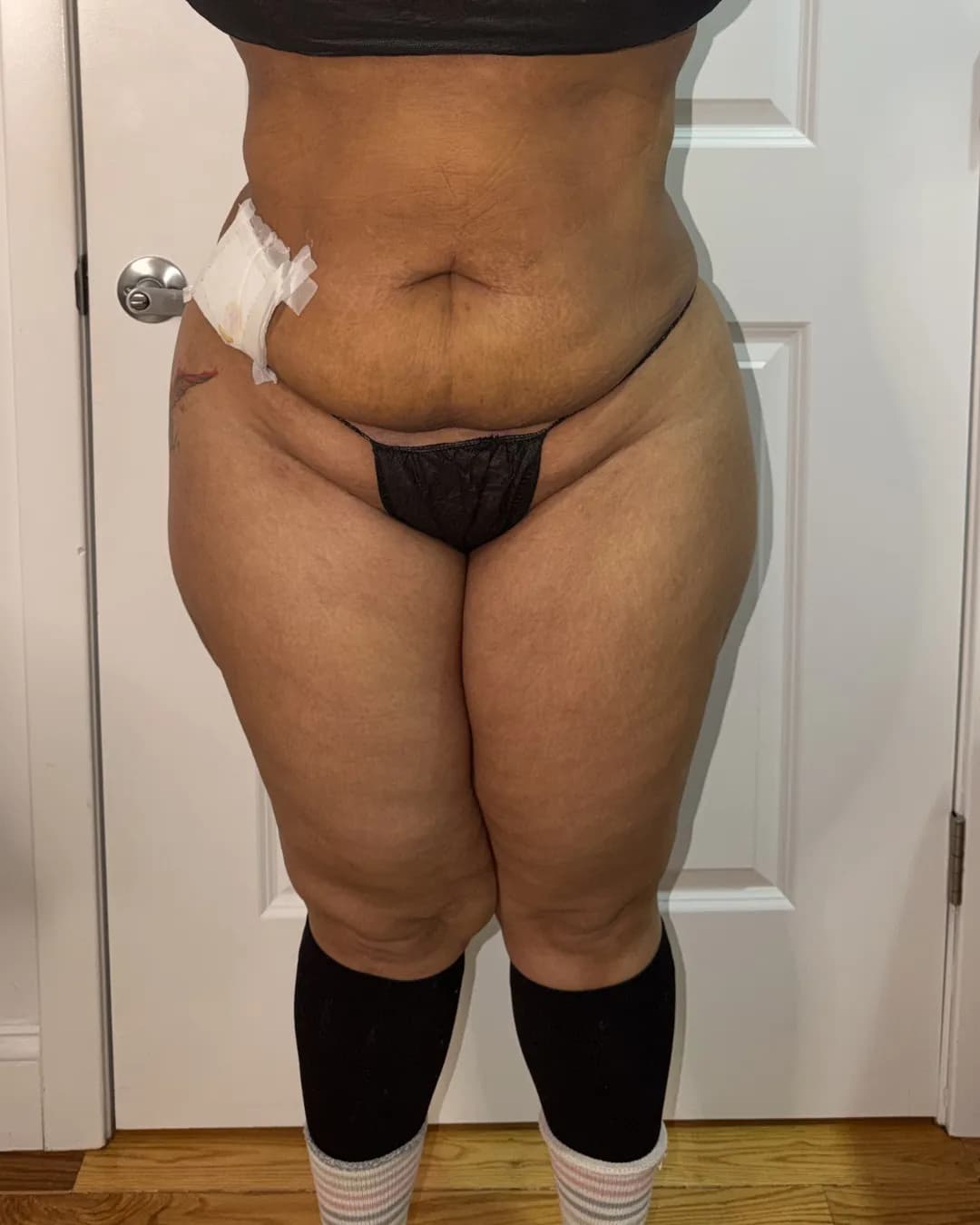 After 360 Liposuction With Hip Dips at Magic Post Op, 1 week of lymphatic drainage post-op recovery progress.