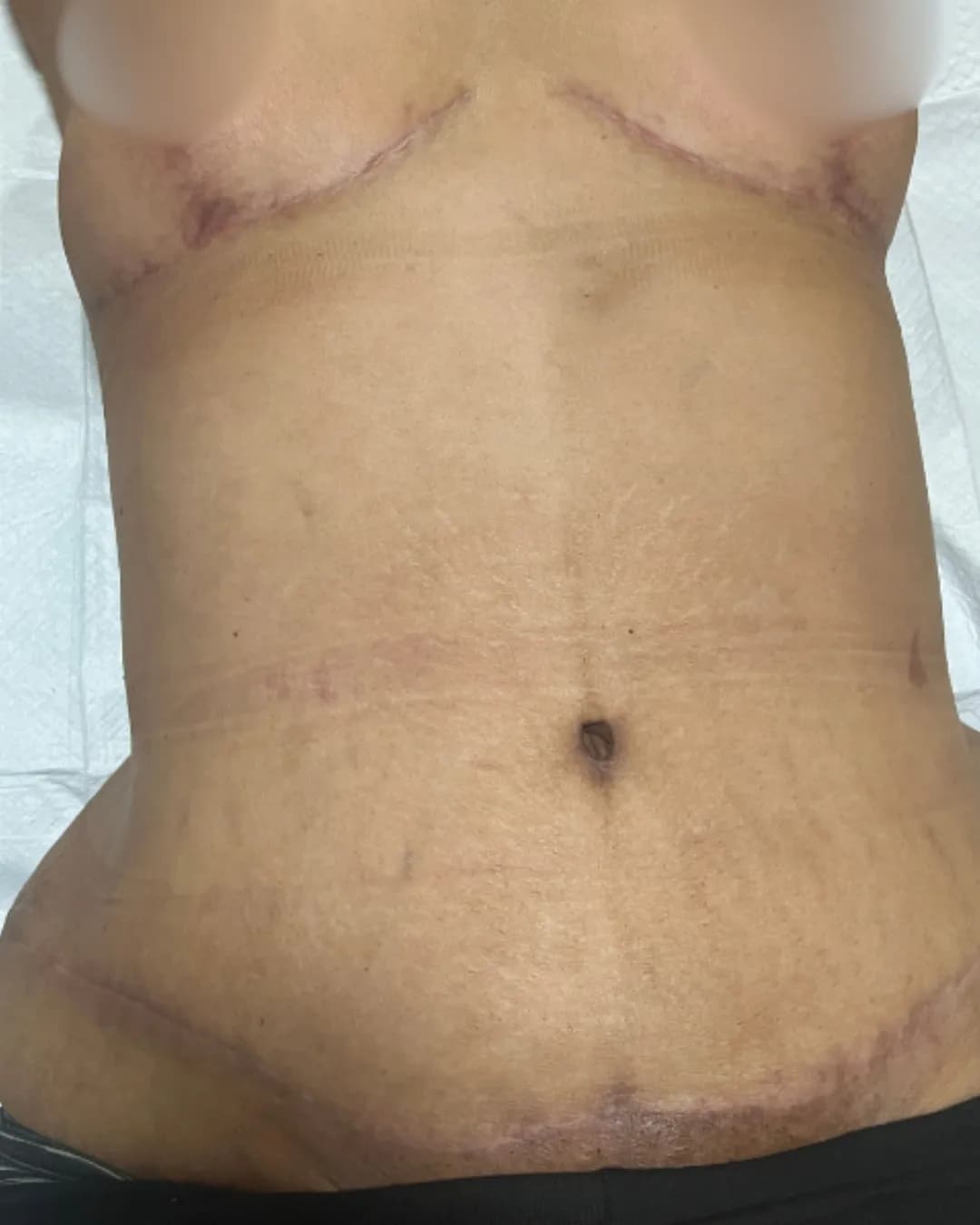 After 360 Lipo With Breast Lift and Tummy Tuck at Magic Post Op, 10 weeks of lymphatic drainage post-op recovery progress.