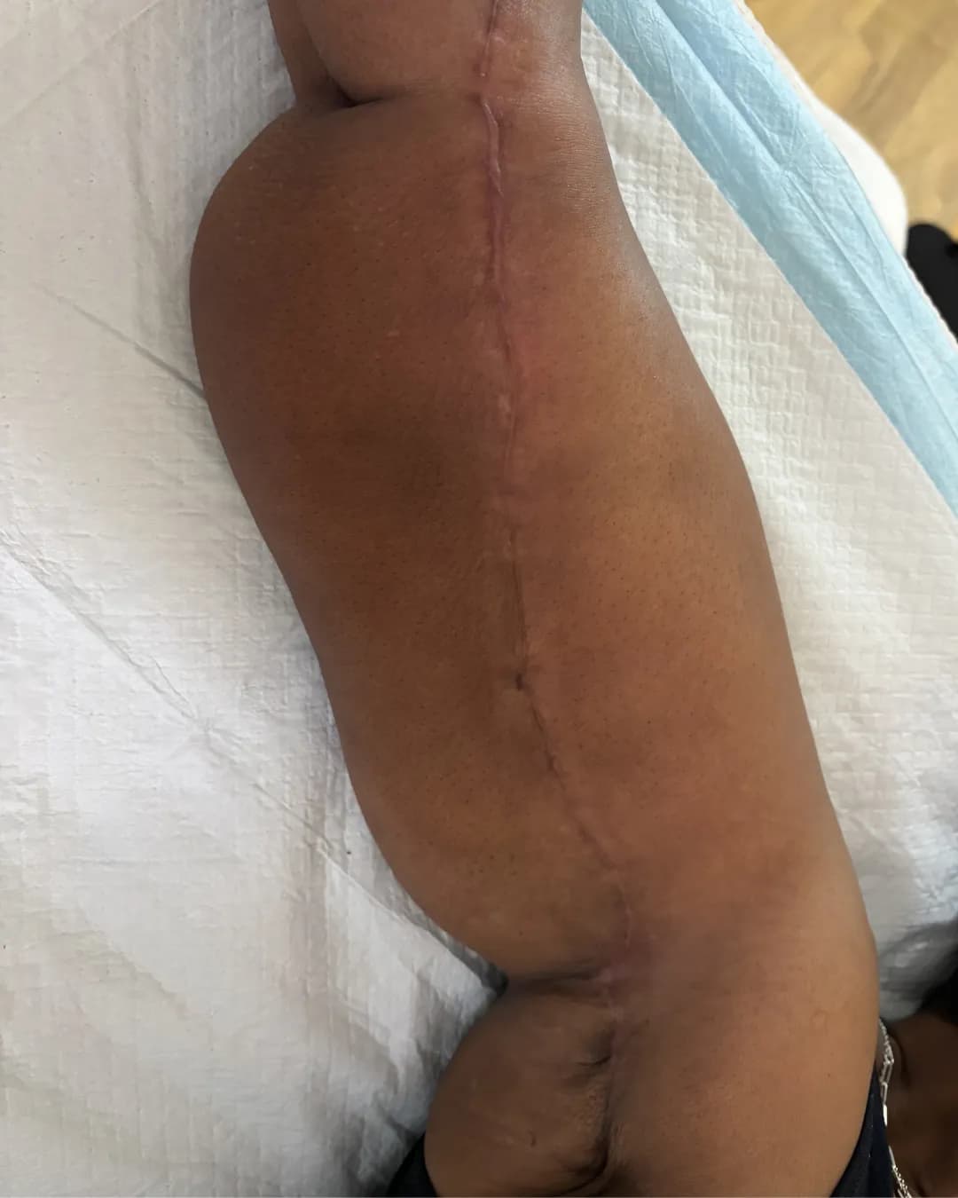 After Liposuction With Brachioplasty (Arm Lift) at Magic Post Op, 10 weeks of lymphatic drainage post-op recovery progress.