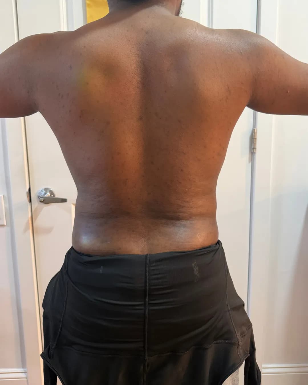 After 360 Liposuction With BBL at Magic Post Op, 12 weeks of lymphatic drainage post-op recovery progress.