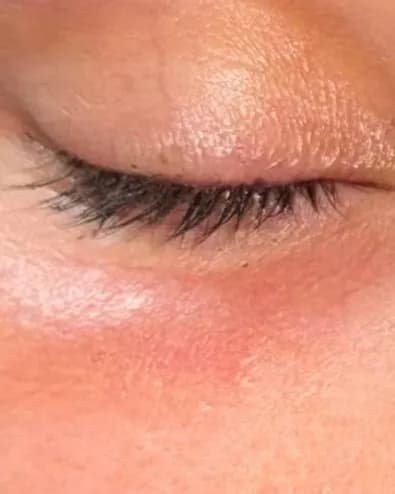 right eyelid procedure